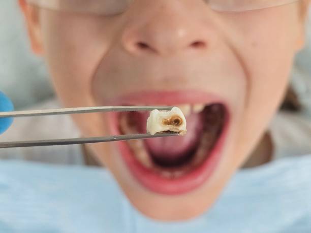 Best Knocked-Out Tooth (Avulsed Tooth) Treatment in Stony Prairie, OH