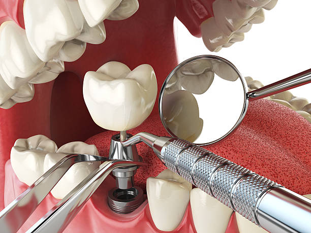 Best Emergency Root Canal Therapy in Stony Prairie, OH